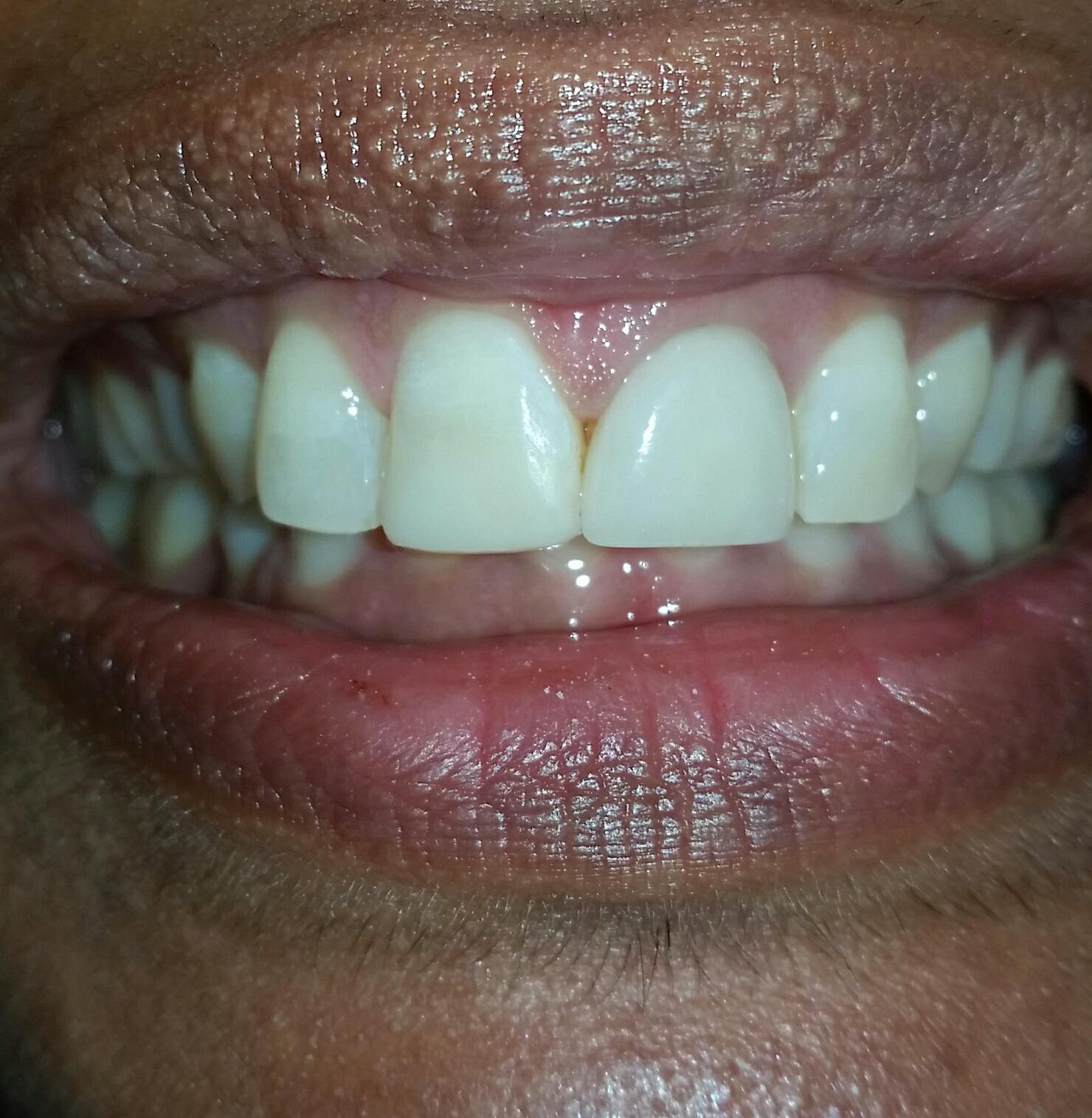 Tooth Bonding Vitality Dental Tuggerah